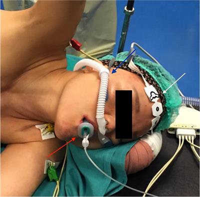 Non-Intubated Thoracic Surgery: Standpoints and Perspectives